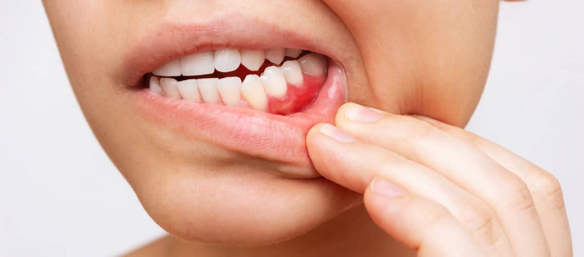 Frau mit schmerzenden Zähnen als Symbol für Parodontose