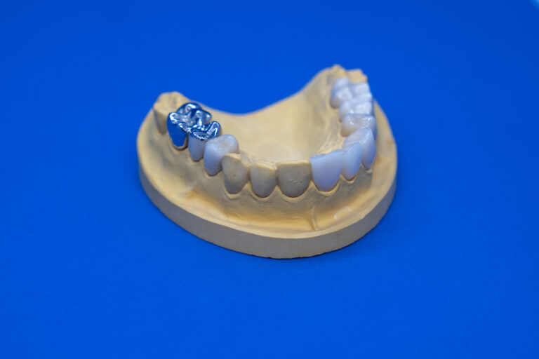 Zahnersatz auf einem Modell, mit metallischem Zahn auf der linken Seite. Hintergrund in Blau.