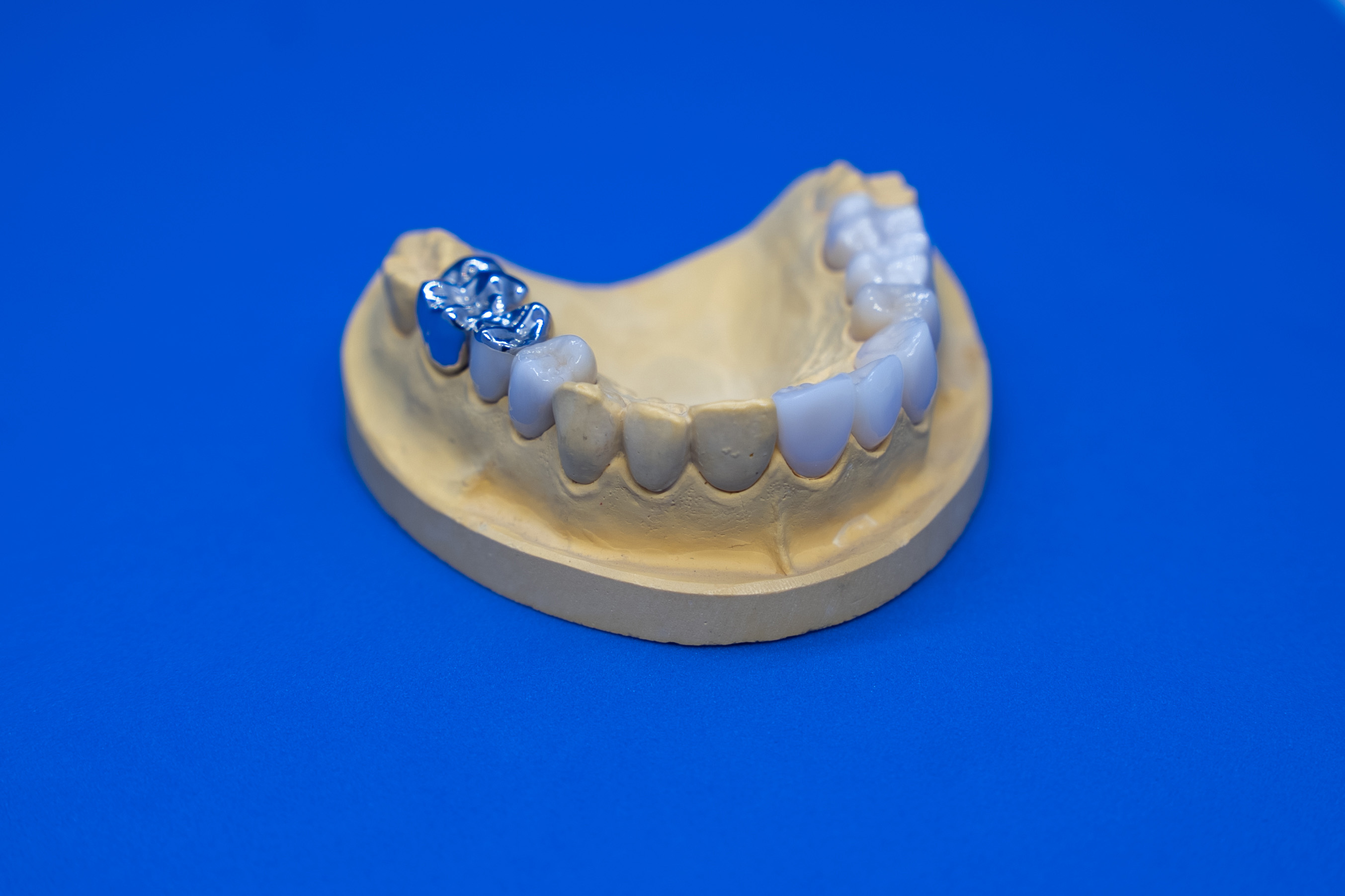 Zahnersatz auf einem Modell, mit metallischem Zahn auf der linken Seite. Hintergrund in Blau.