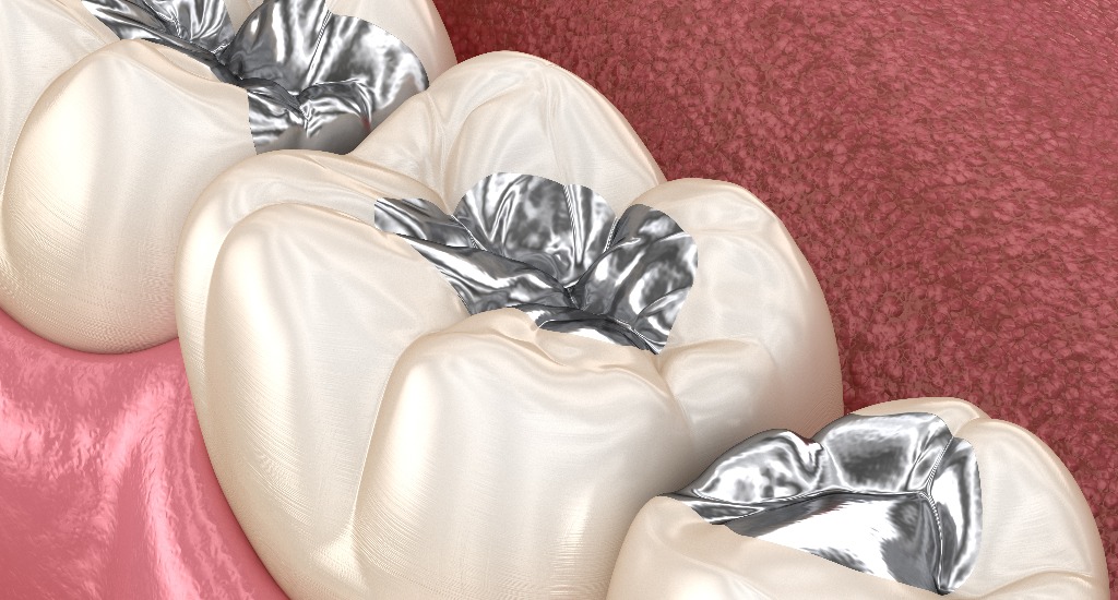 Amalgam-Restauration. Medizinisch exakte 3D-Animation eines zahnmedizinischen Konzepts